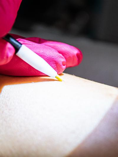 Elektroepilation zur gezielten Behandlung einzelner Haarfollikel