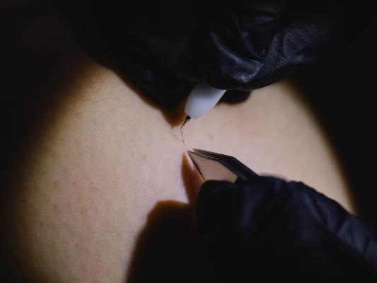 Ist Elektroepilation dauerhaft?
