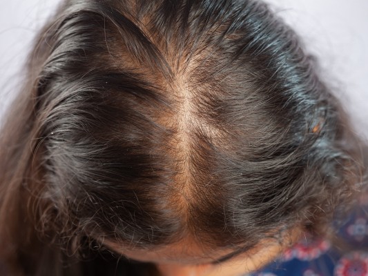 Diffuser Haarausfall mit gleichmäßigem Haarverlust am Oberkopf