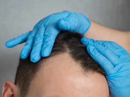 Unnatürliche Ergebnisse nach Haartransplantation – Ursachen und Korrektur