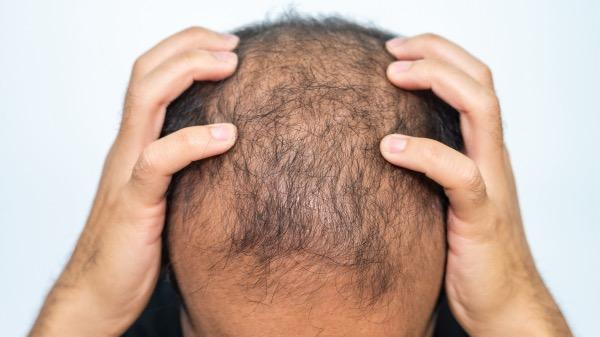 Mißglückte Haartransplantation, Haarentferung, Mann fasst sich an den Kopf