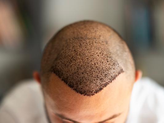 Missglückte Haartransplantation: Wenn Haare zu dicht oder zu kräftig wirken