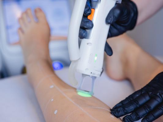 Medizinische Laser-Haarentfernung mit Alexandritlaser während der Behandlung